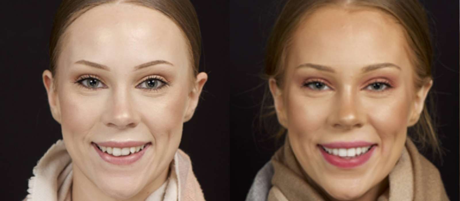 Clear Aligners Before