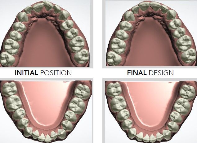 Clear Aligner treatment planning - Active Aligners