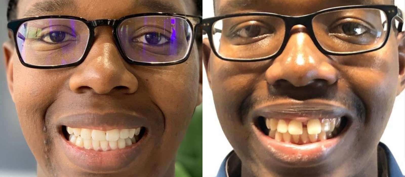 Before and After Active Aligners - Clear Aligners