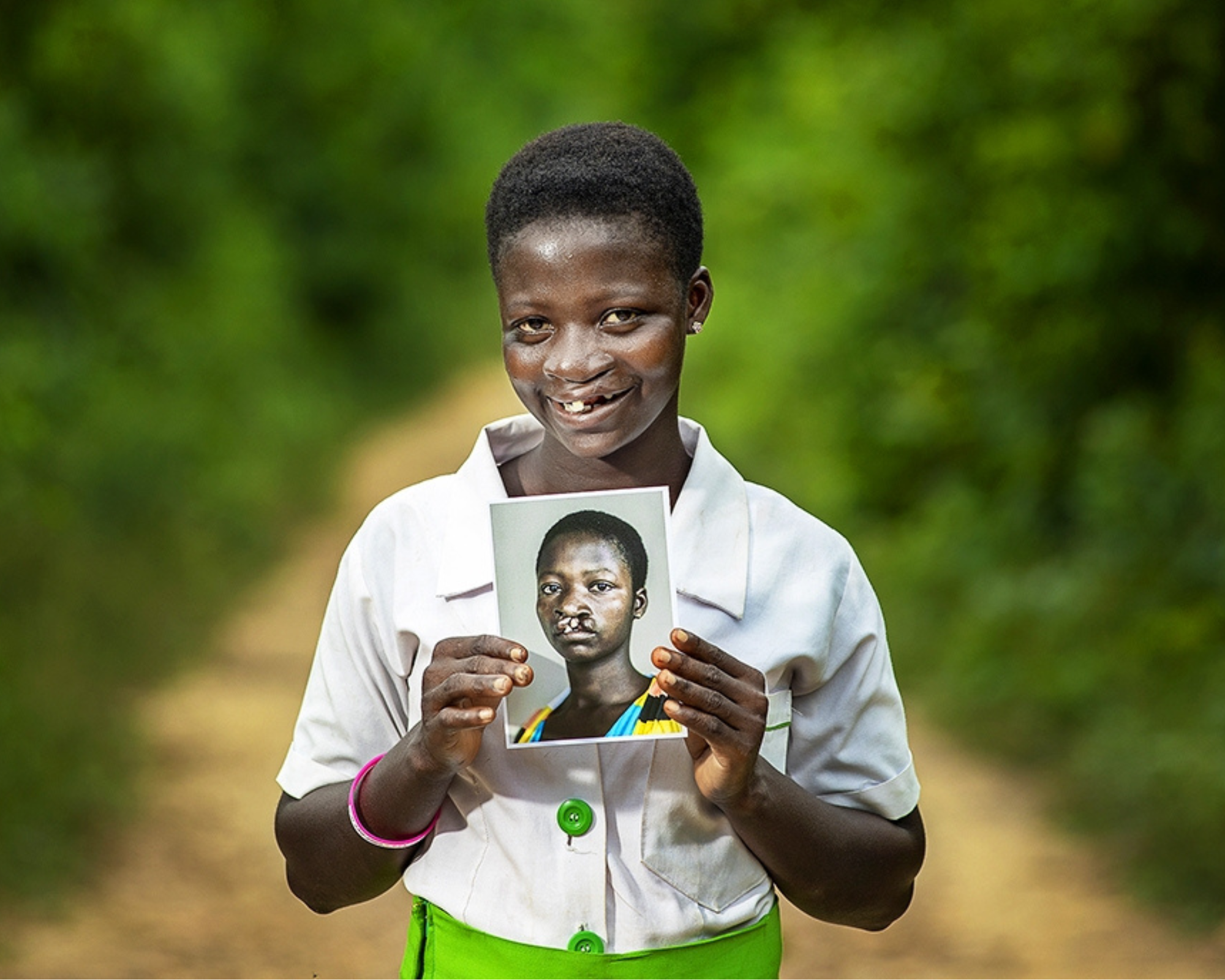 Operation Smile South Africa patient
