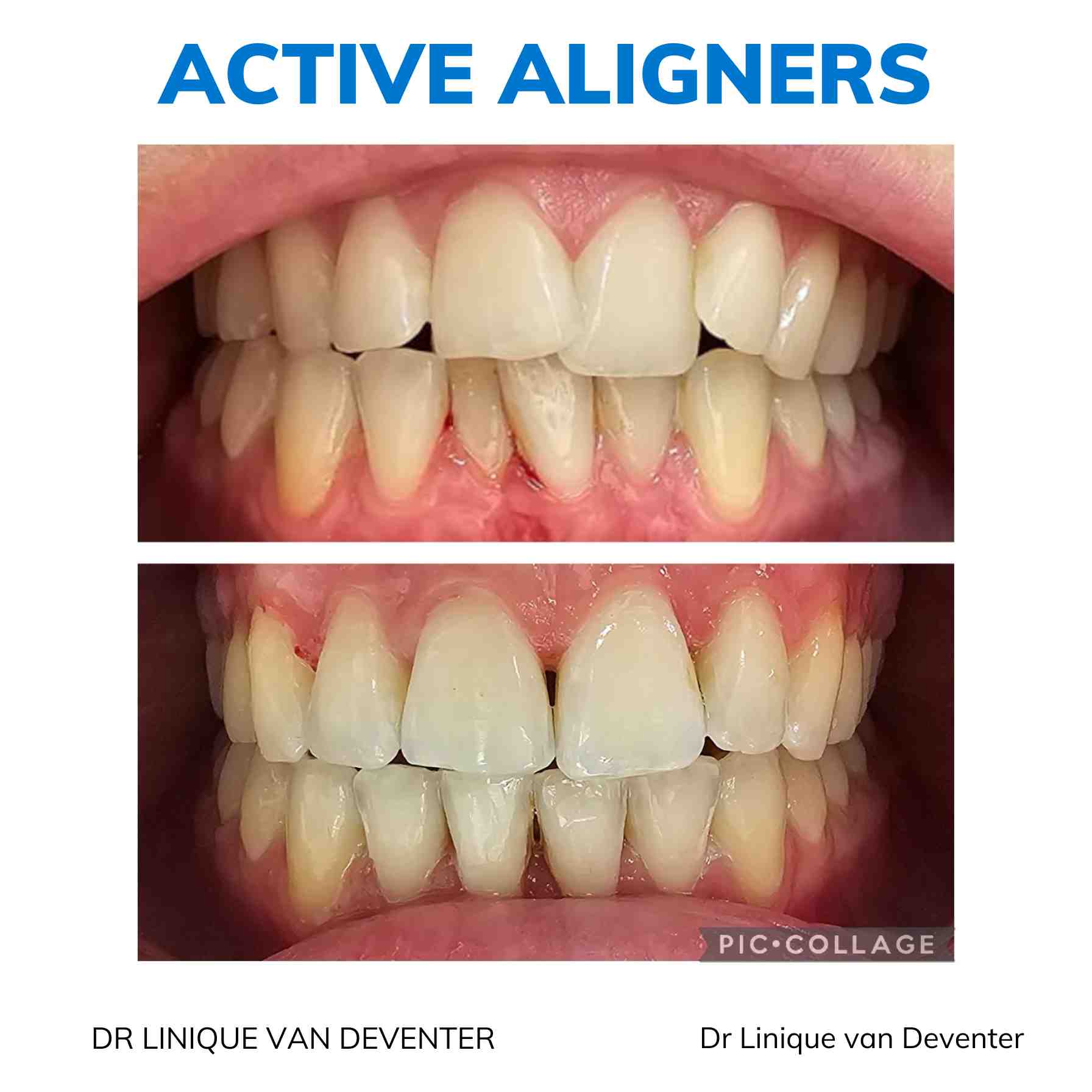 Active Aligners before and after result