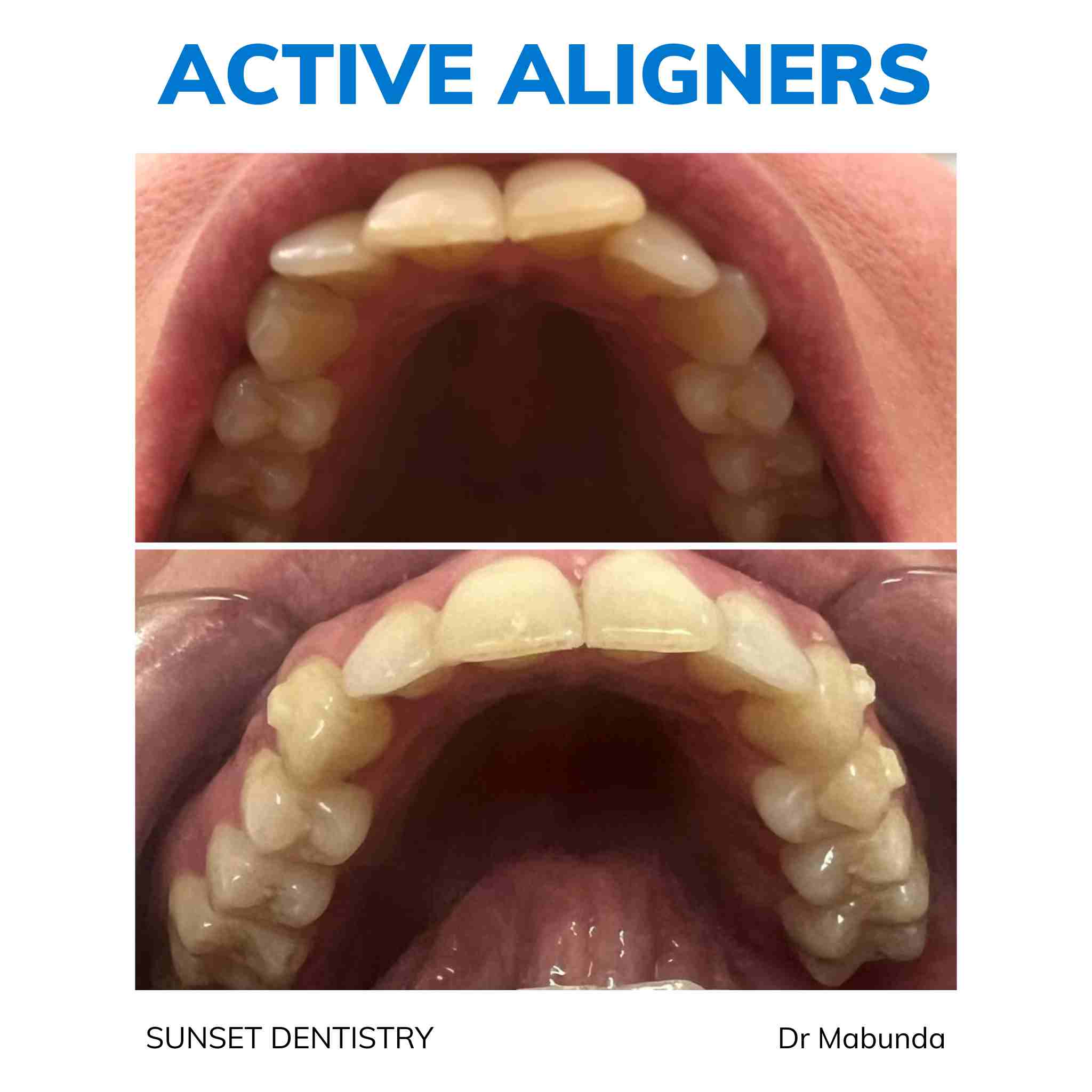 Active Aligners before and after result