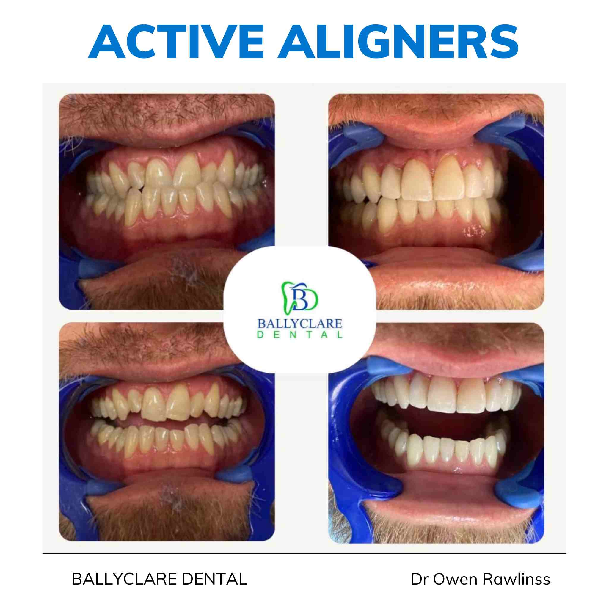 Active Aligners before and after result