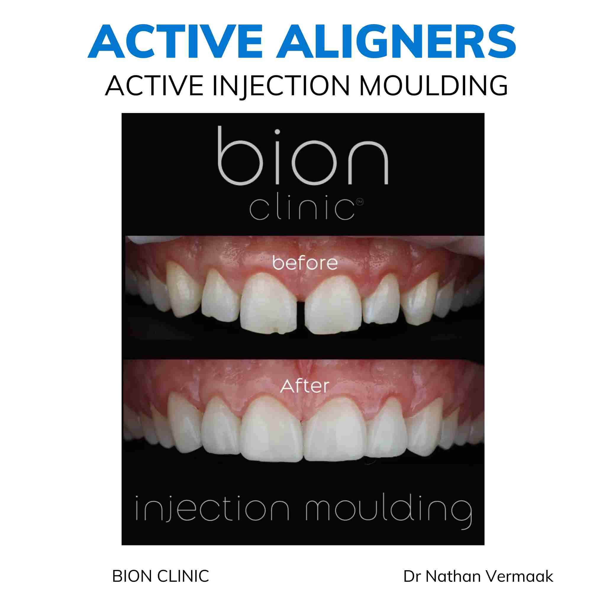Active Aligners before and after result
