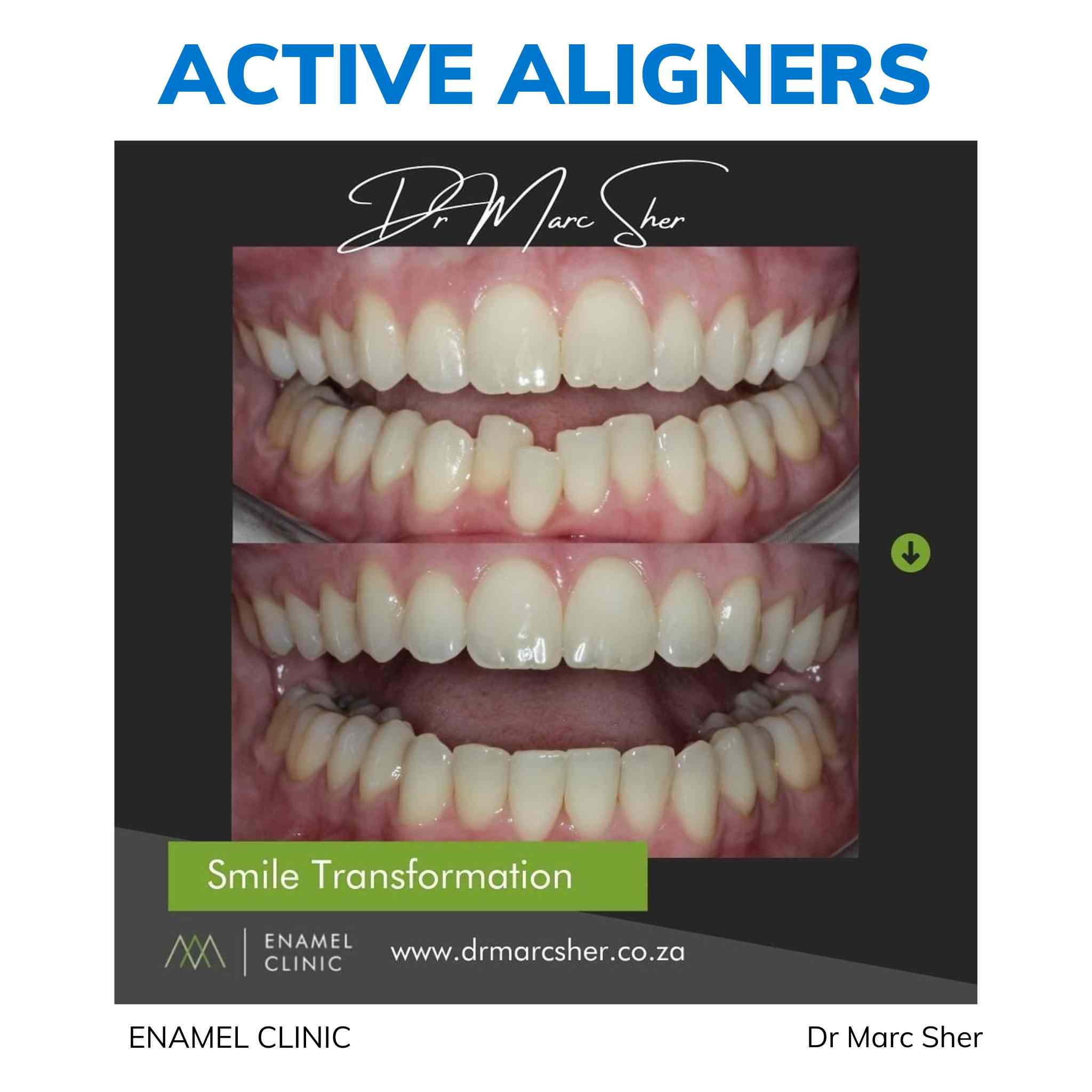 Active Aligners before and after result