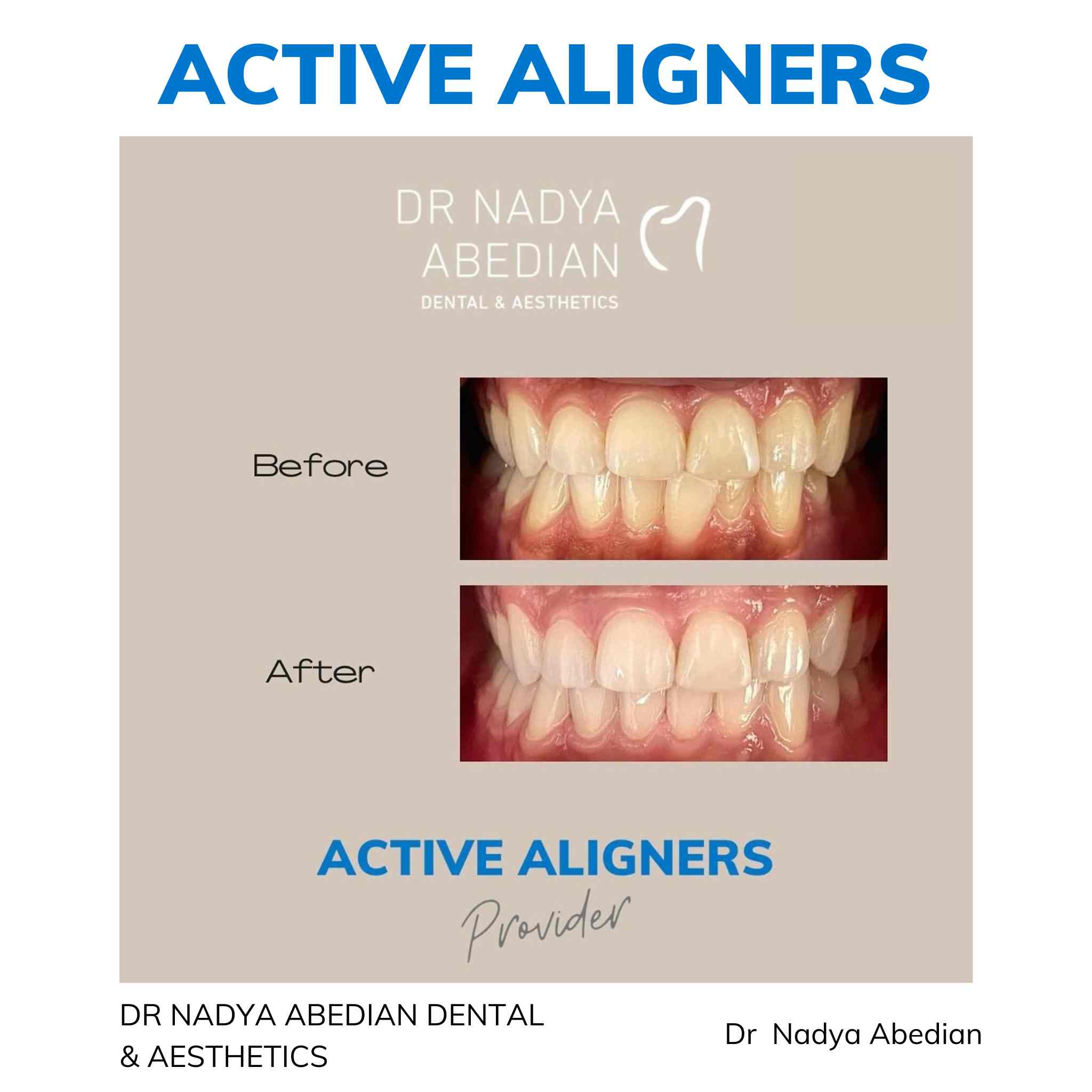 Active Aligners before and after result