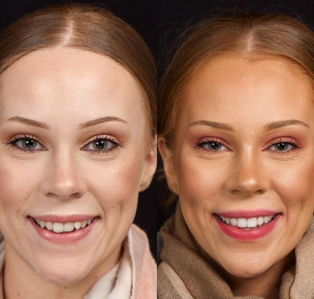 Before and after Active Aligners, female patient