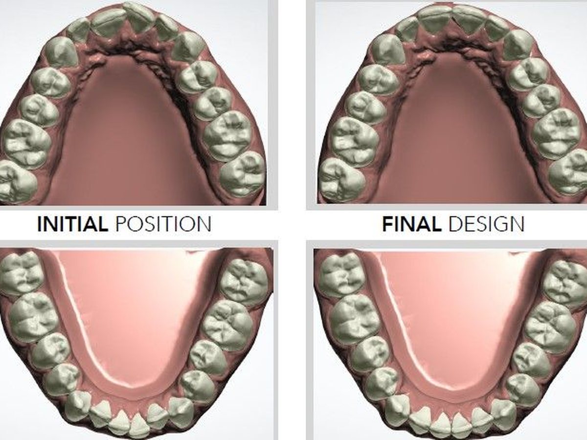 Illustrative example of a digital Active Aligners treatment plan showing initial and expected final tooth positions