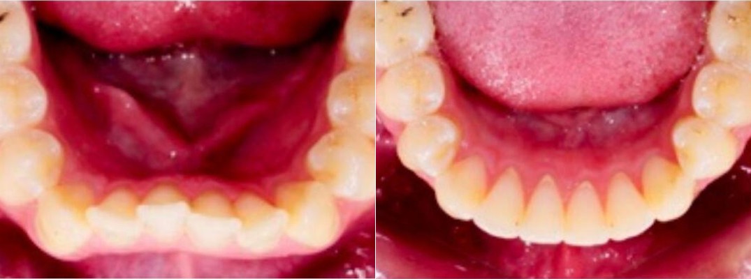 Lower arch before and after Active Aligners treatment, crowding gently straightened