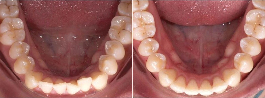 Lower arch before and after Active Aligners, a second South African case with the lower teeth aligned