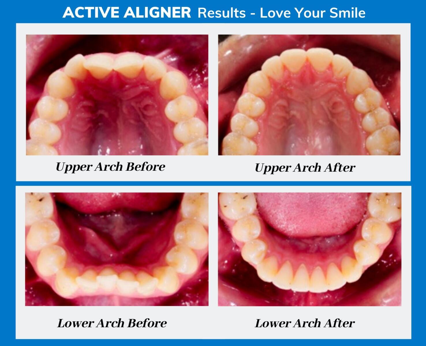 Upper and lower arch before and after Active Aligners treatment on a South African patient, all four views