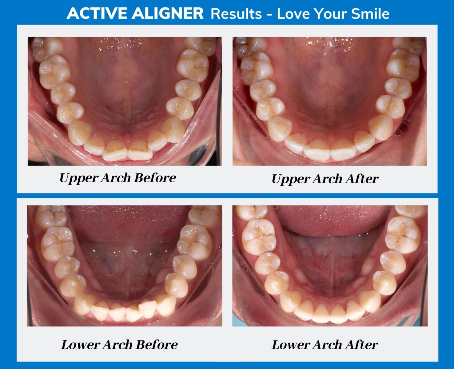 A second South African Active Aligners patient, upper and lower arch shown before and after treatment