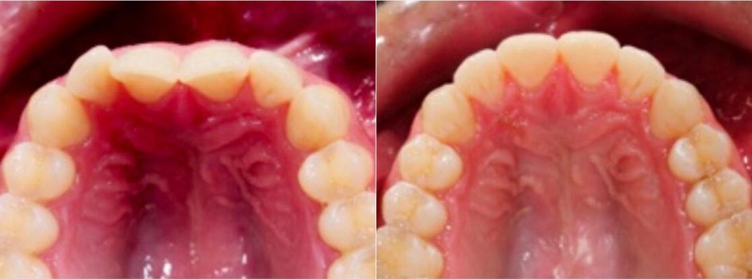 Upper arch before and after Active Aligners treatment, teeth moved into an even line