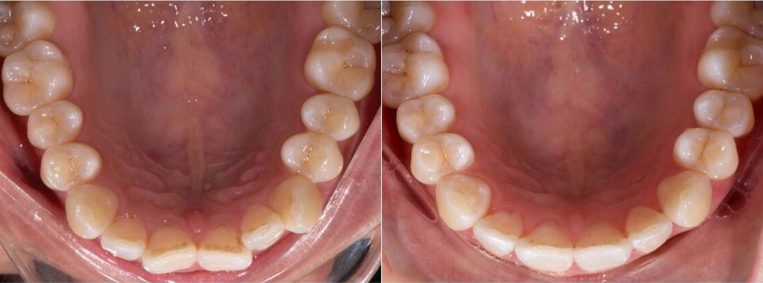 Upper arch before and after Active Aligners, a second South African case with a wider, evener arch