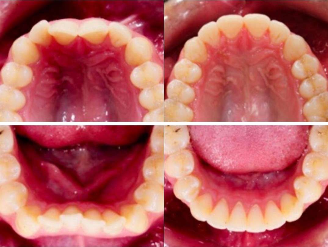 Active Aligners before and after in South Africa, one patient's upper and lower arch across all four views