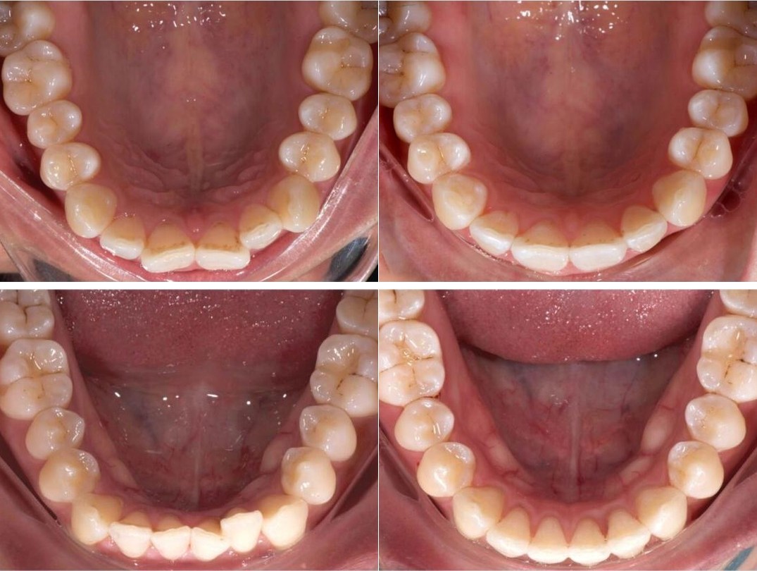 Another South African Active Aligners case, the upper and lower arch before and after treatment