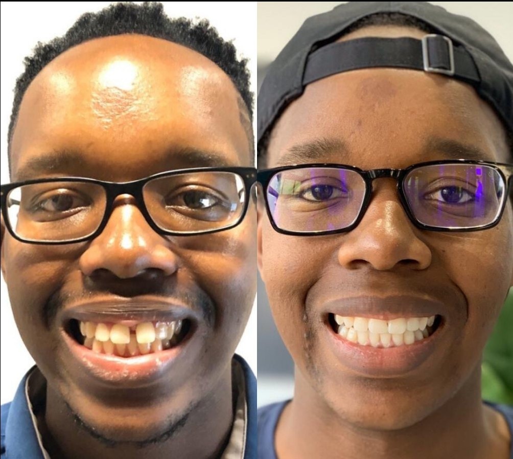 Before and after Active Aligners, male patient