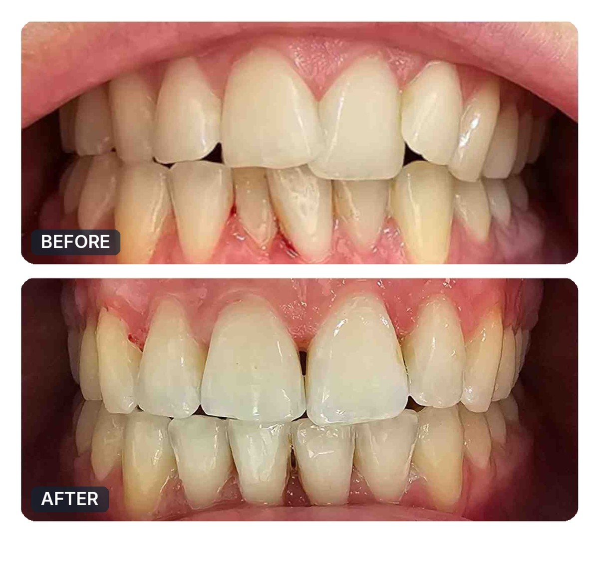 Active Aligners before and after, case 1