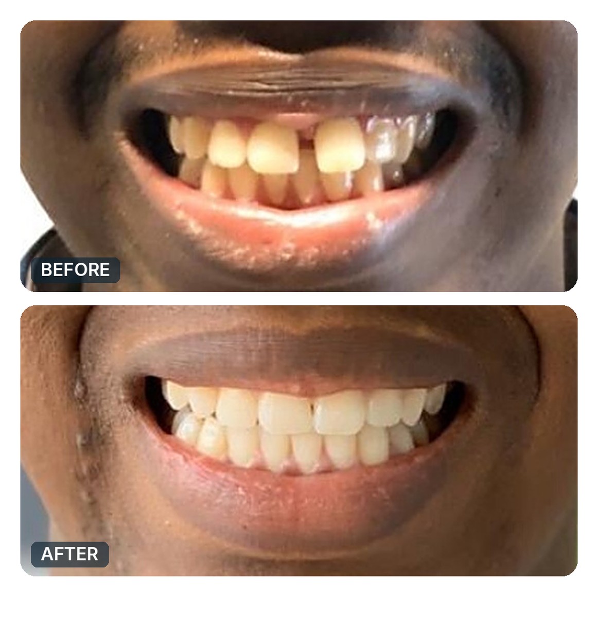 Active Aligners before and after, gap closed