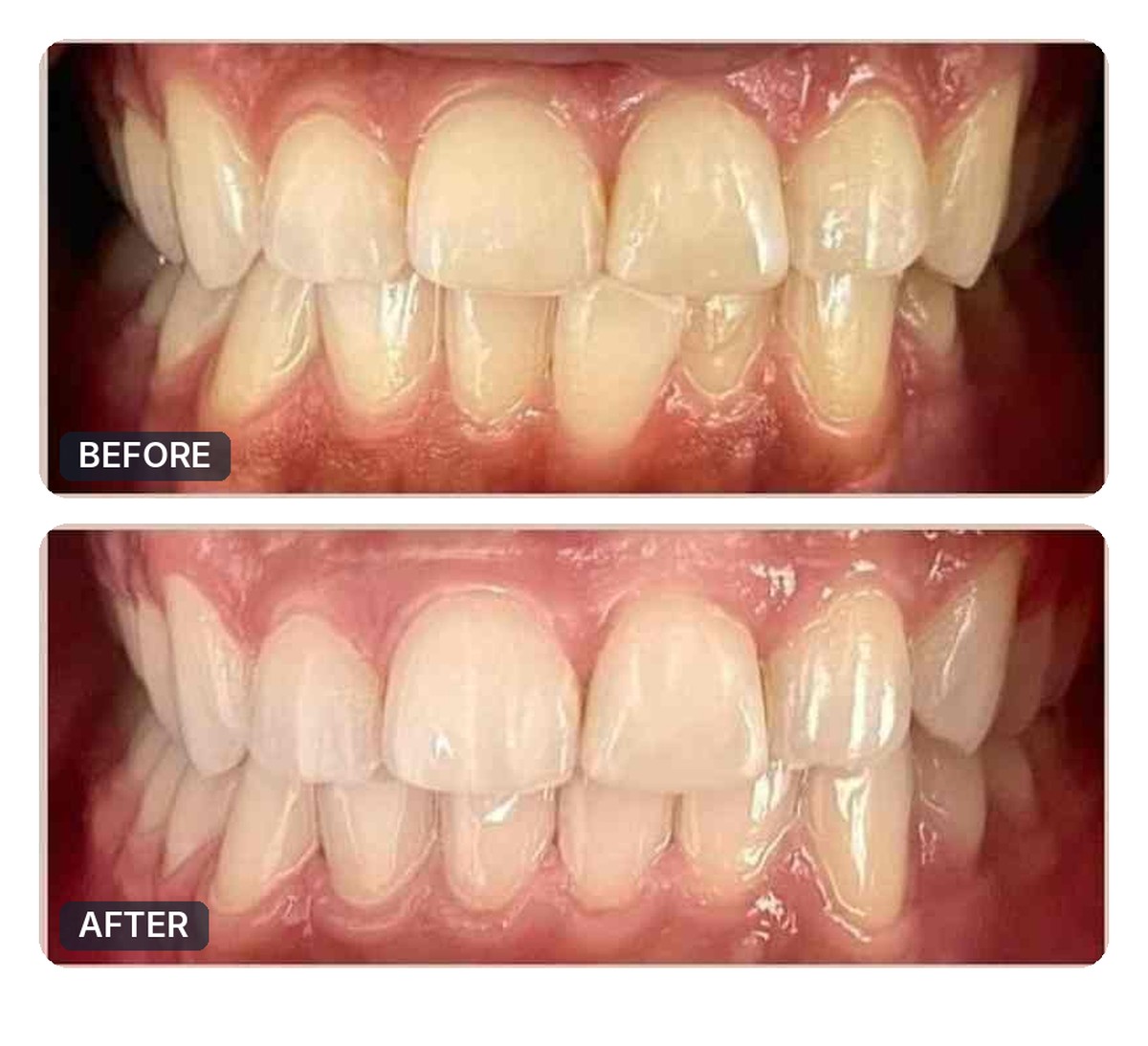 Active Aligners before and after, case 7