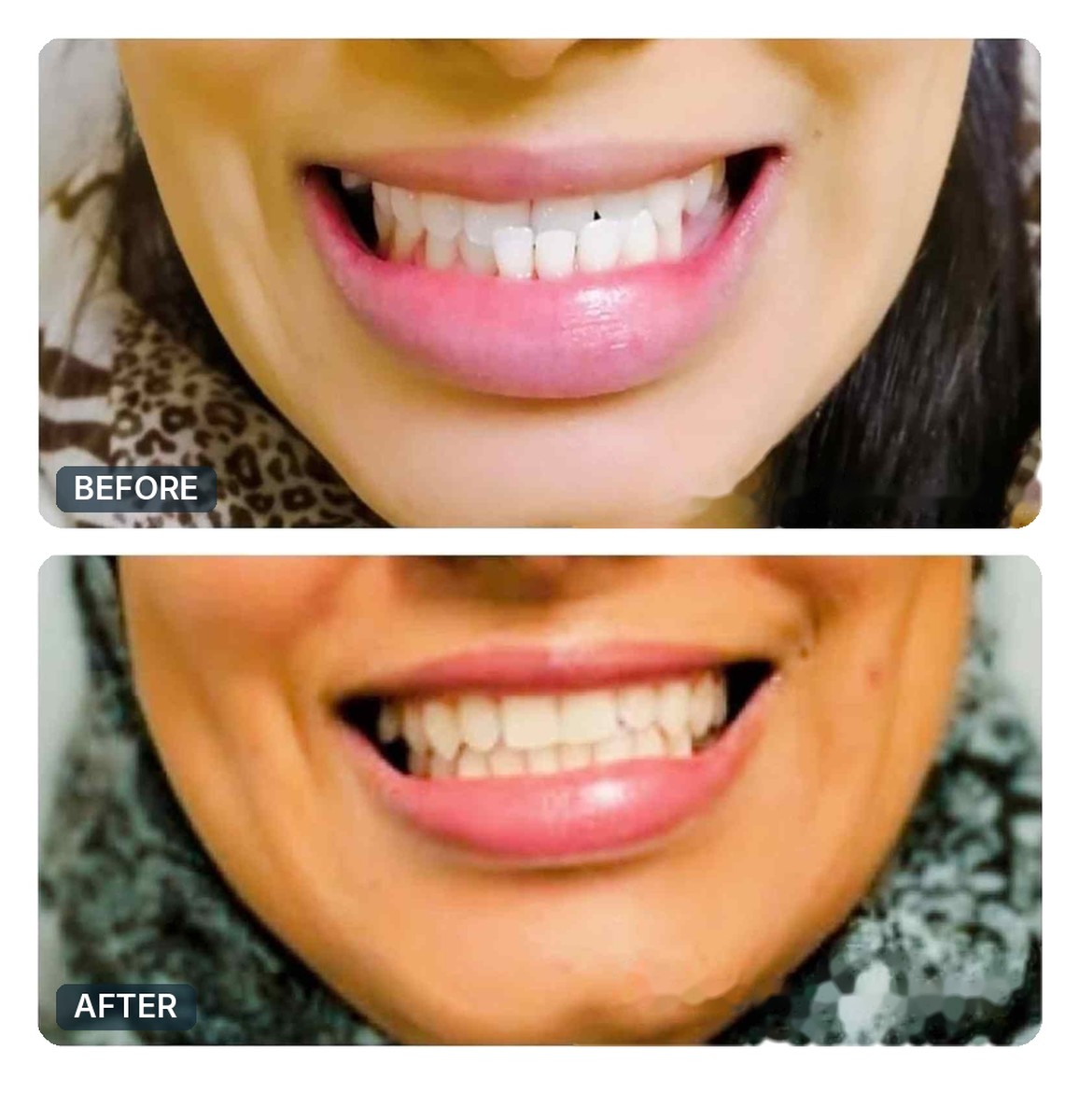 Active Aligners before and after, case 8