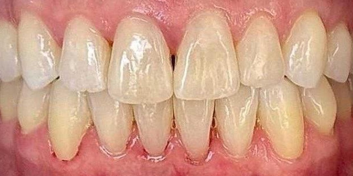After Active Aligners treatment, front view, treated by Dr Nadya Abedian