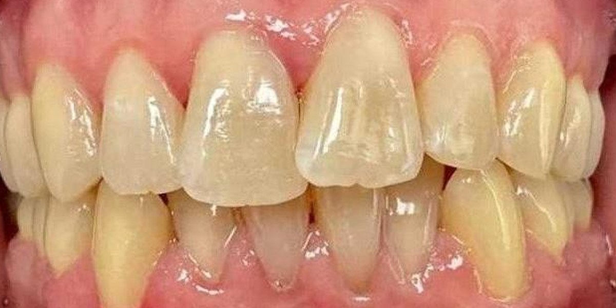 Before Active Aligners treatment, front view, crowded, treated by Dr Nadya Abedian