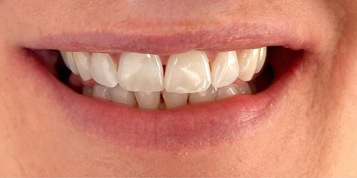 After Active Aligners treatment, smile, treated by Dr Nadya Abedian