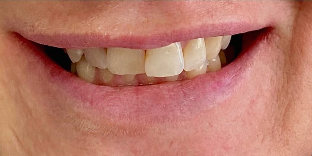 Before Active Aligners treatment, smile, crowded, treated by Dr Nadya Abedian