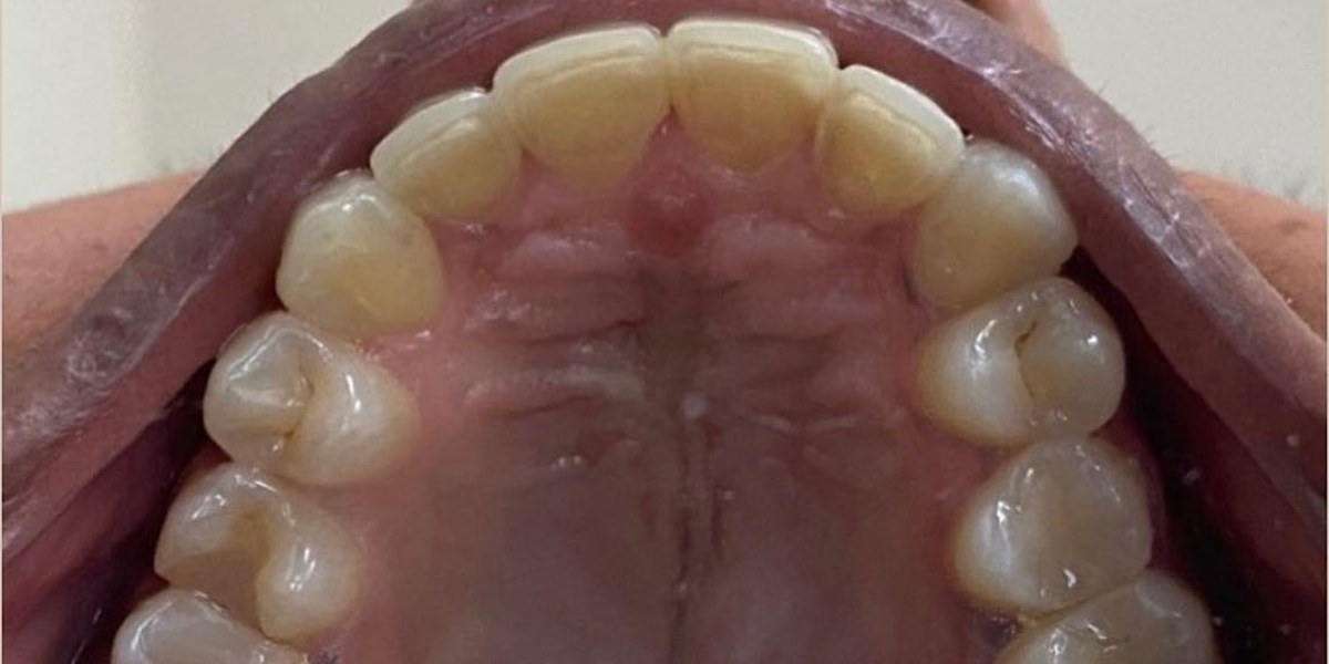 After Active Aligners treatment, upper teeth from above, treated by Dr Nadya Abedian