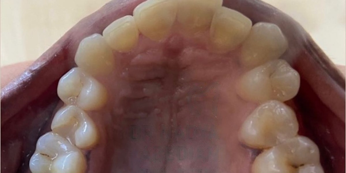 Before Active Aligners treatment, upper teeth from above, crowded, treated by Dr Nadya Abedian