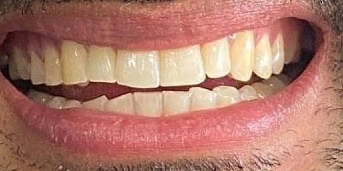 After Active Aligners treatment, smile, treated by Dr Nadya Abedian