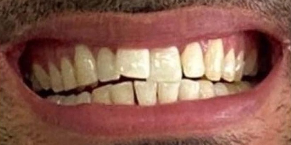 Before Active Aligners treatment, smile, crowded, treated by Dr Nadya Abedian