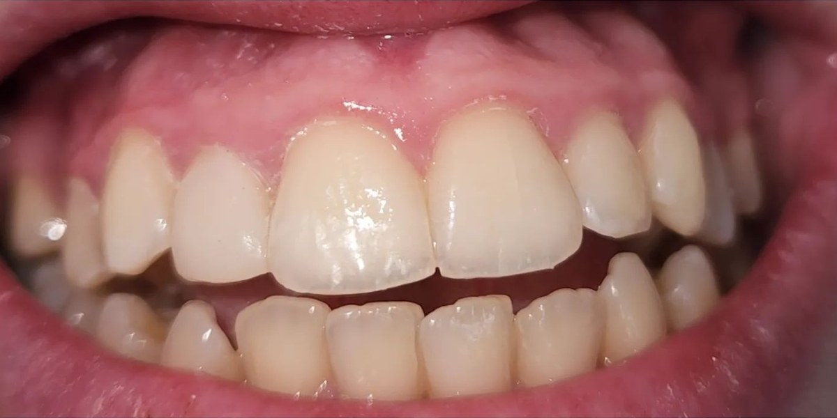 After Active Aligners treatment, front view, treated by Dr Jessica Summerscales