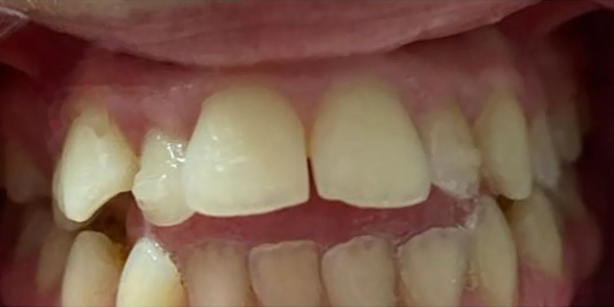 Before Active Aligners treatment, front view, crowded, treated by Dr Jessica Summerscales