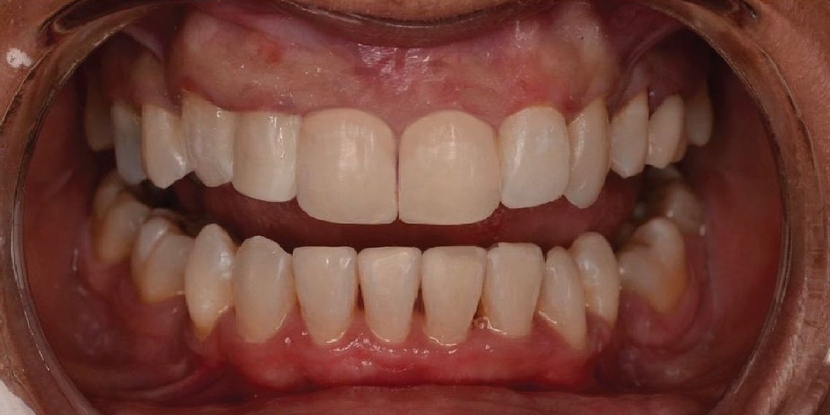 After Active Aligners treatment, front view, treated by Dr Hannes Scheepers