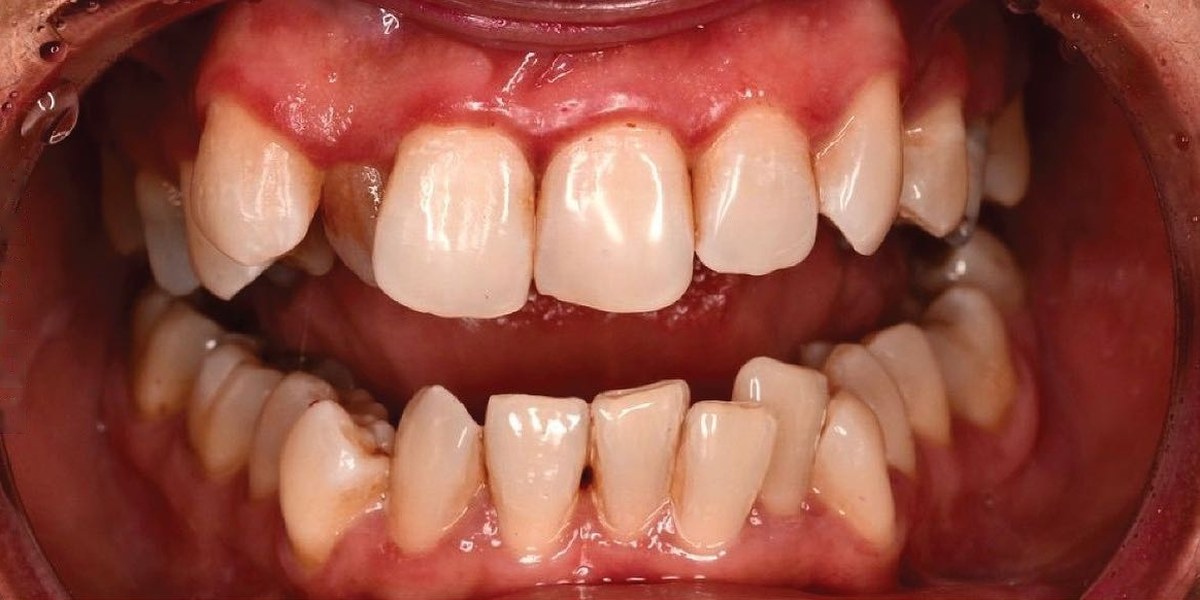 Before Active Aligners treatment, front view, crowded, treated by Dr Hannes Scheepers