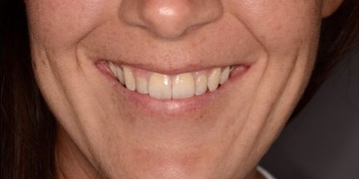 After Active Aligners treatment, smile, treated by Dr Hannes Scheepers