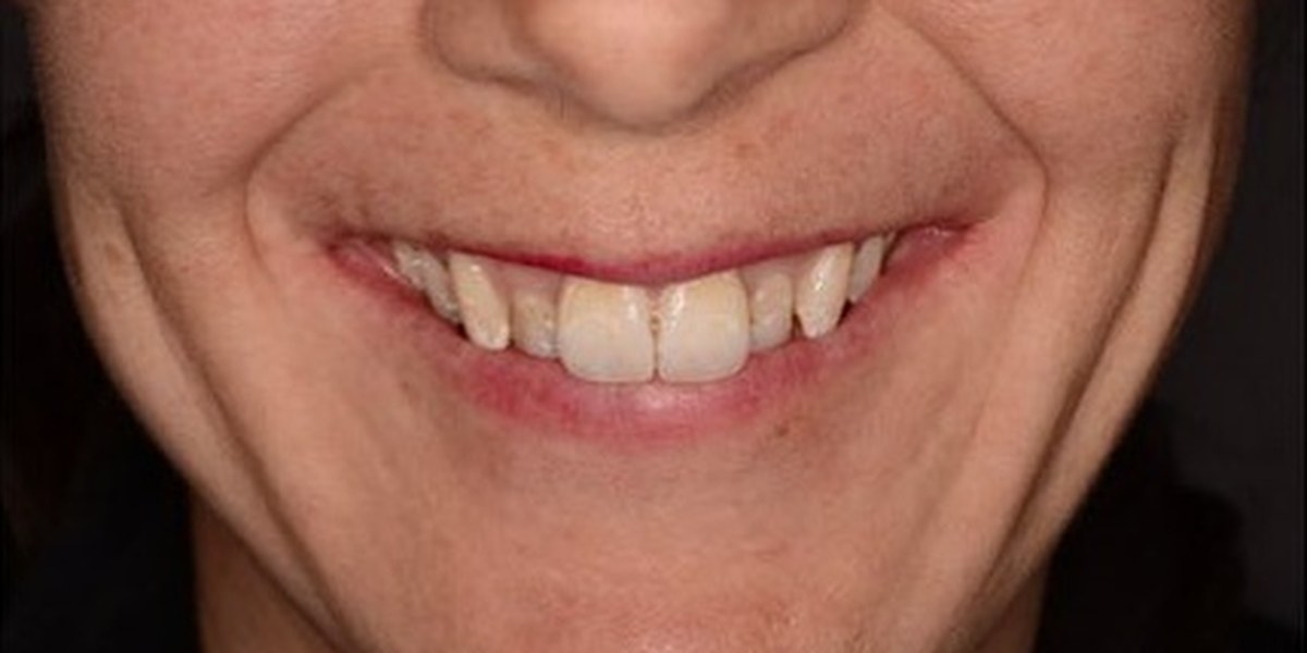 Before Active Aligners treatment, smile, crowded, treated by Dr Hannes Scheepers