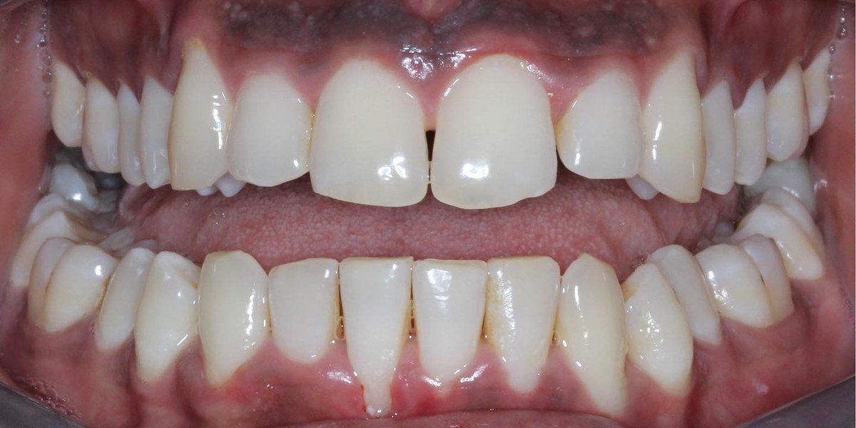 After Active Aligners treatment, front view, treated by Dr Marc Sher
