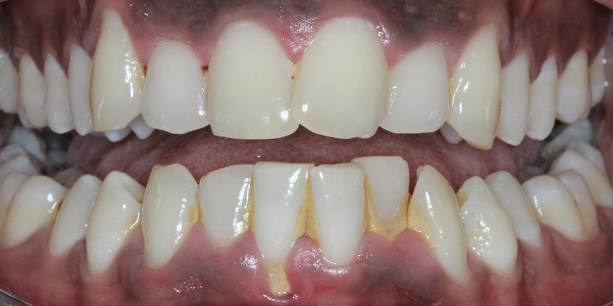 Before Active Aligners treatment, front view, crowded, treated by Dr Marc Sher