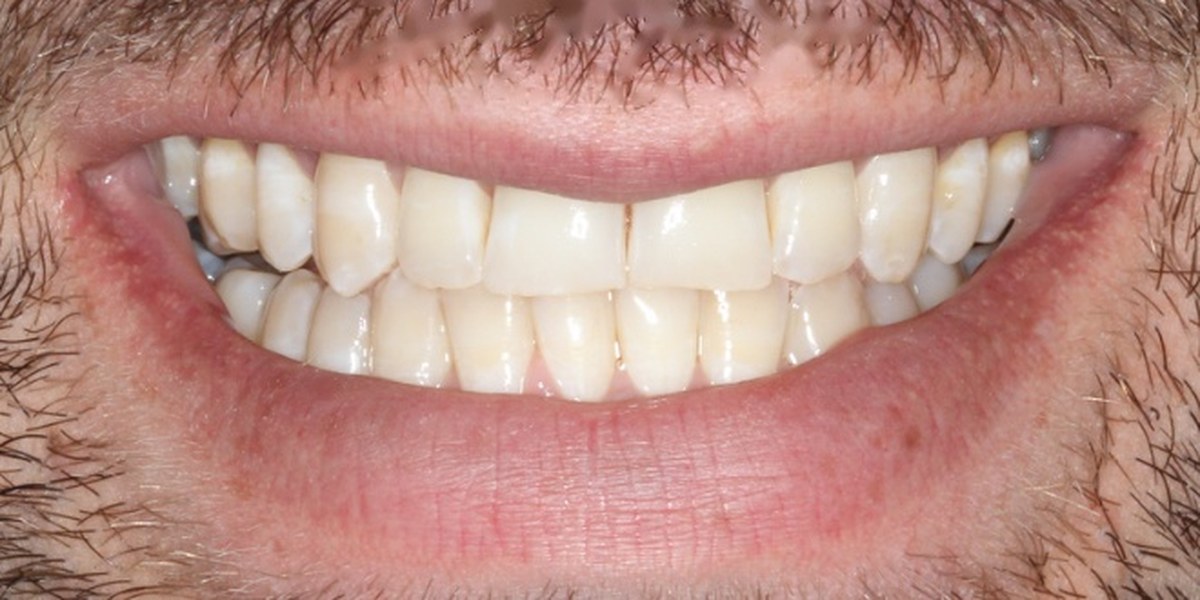 After Active Aligners treatment, smile, treated by Dr Marc Sher
