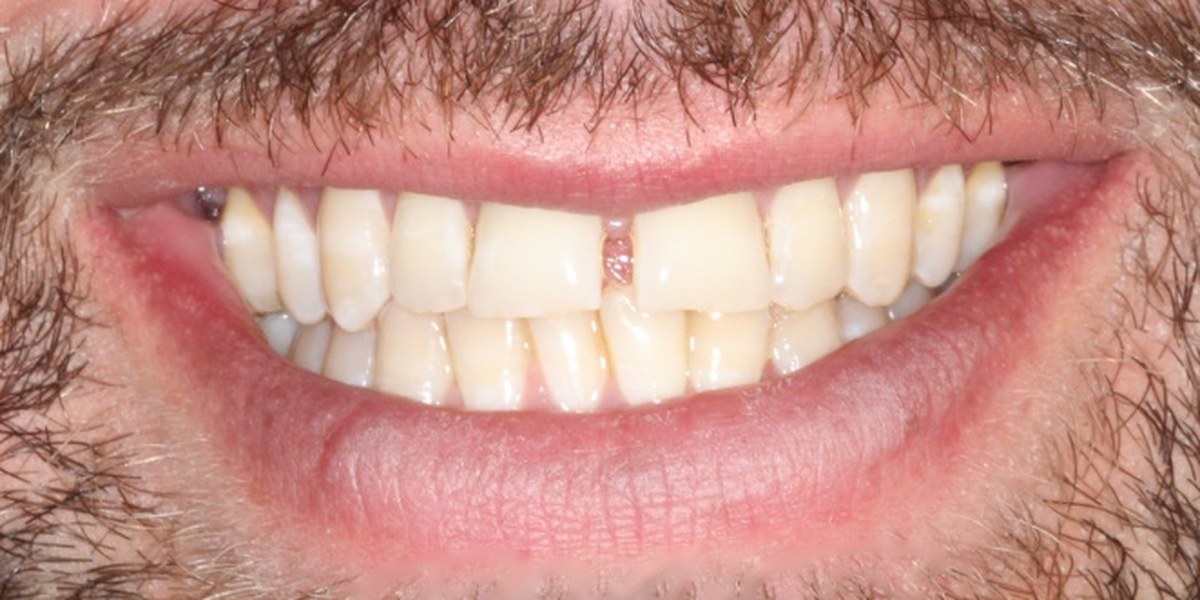 Before Active Aligners treatment, smile, gaps, treated by Dr Marc Sher
