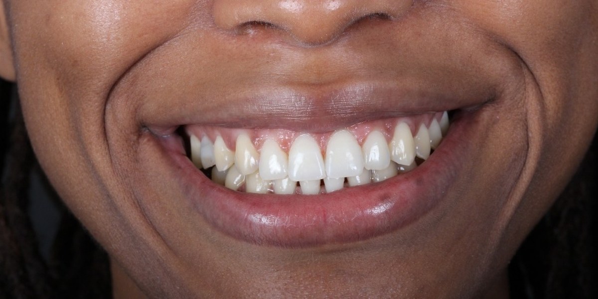 After Active Aligners treatment, smile, treated by Dr Marc Sher