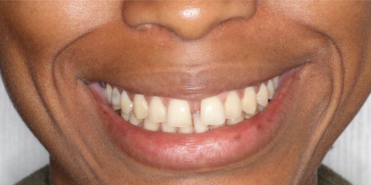 Before Active Aligners treatment, smile, gaps, treated by Dr Marc Sher