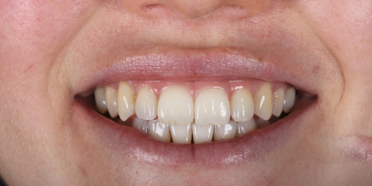 After Active Aligners treatment, smile, treated by Dr Marc Sher