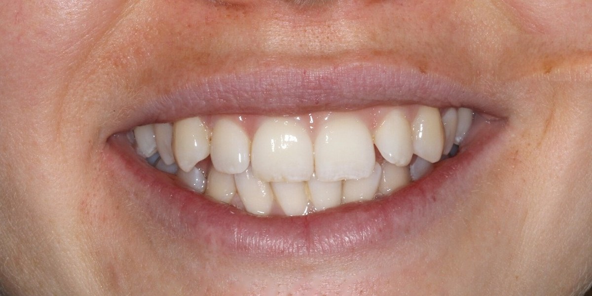 Before Active Aligners treatment, smile, crowded, treated by Dr Marc Sher