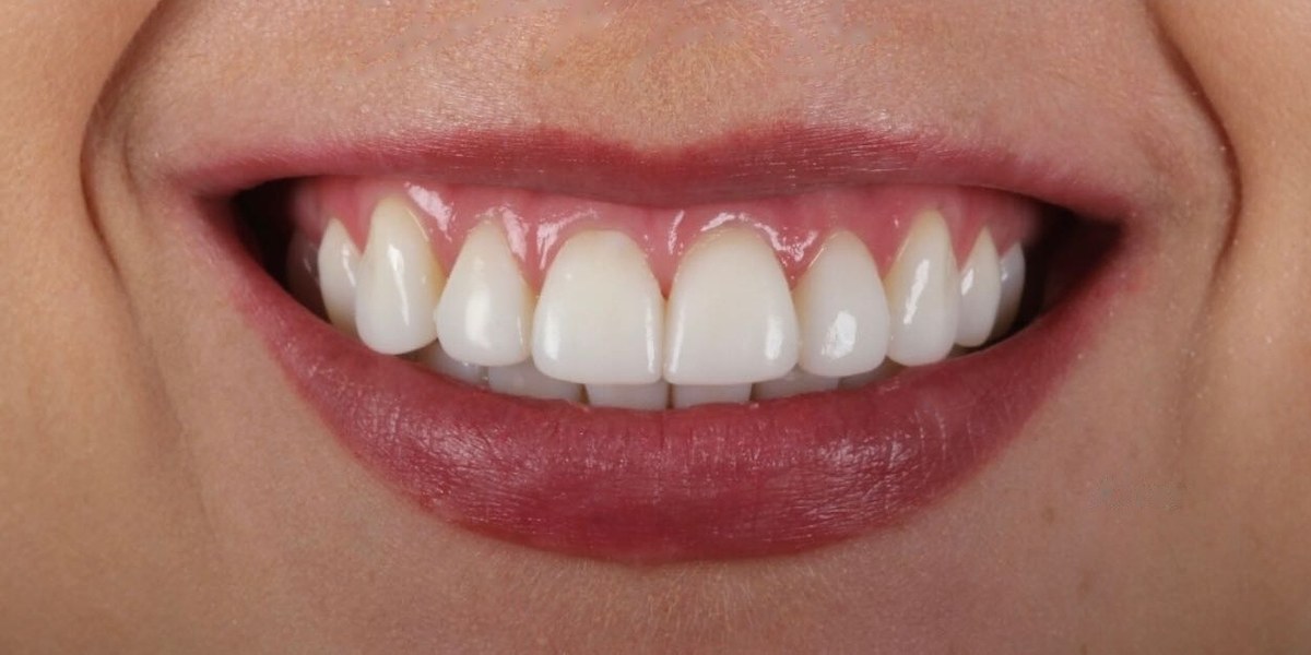 After Active Aligners treatment, smile, treated by Dr Marc Sher