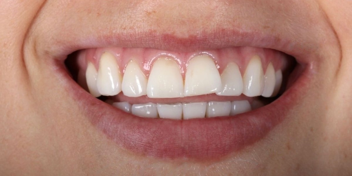 Before Active Aligners treatment, smile, crowded, treated by Dr Marc Sher