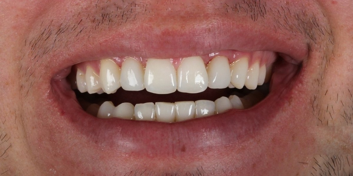 After Active Aligners treatment, smile, treated by Dr Marc Sher